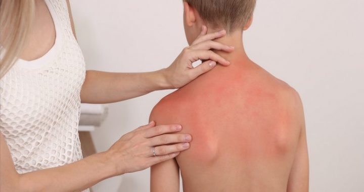 Ko darīt, ja bērns pārkarsis un apdedzis saulē. Bērnu slimnīcas speciālistu ieteikumi