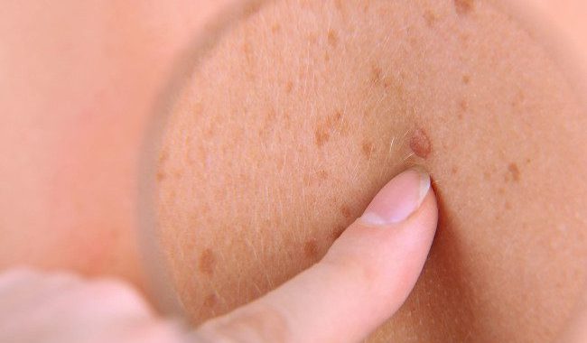 Ādas vēzis: pazīmes, profilakse un ārstēšana – dermatologa padomi