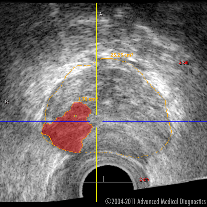 Ar 3D histoskeneri var „ieraudzīt” prostatas vēzi